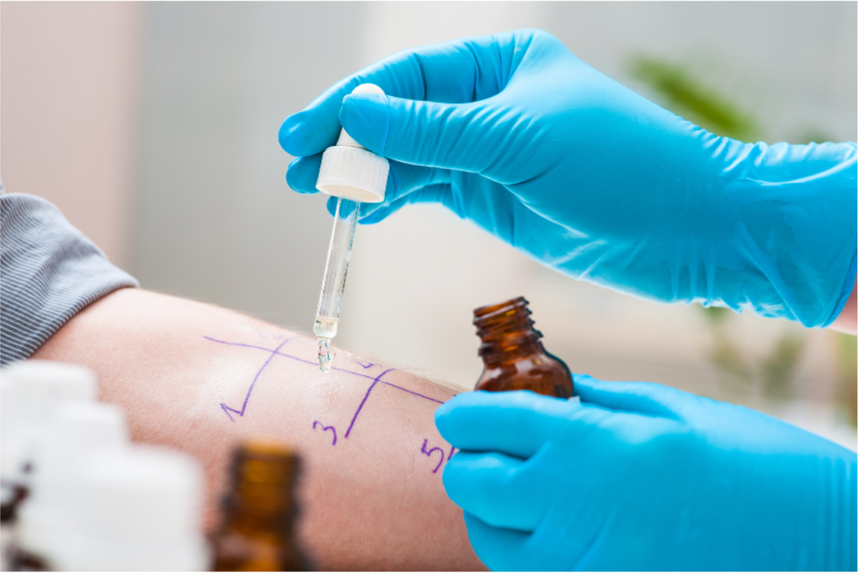 allergy testing by dropping a fluid into the skin